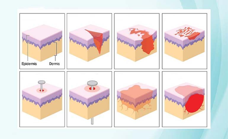 Yaralanma Çeşitleri